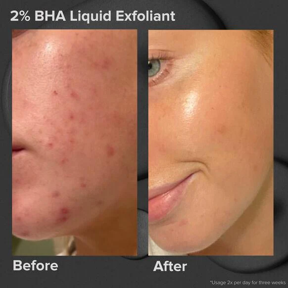 Paula's Choice Multi-Level Exfoliation Trial Kit - Image 6